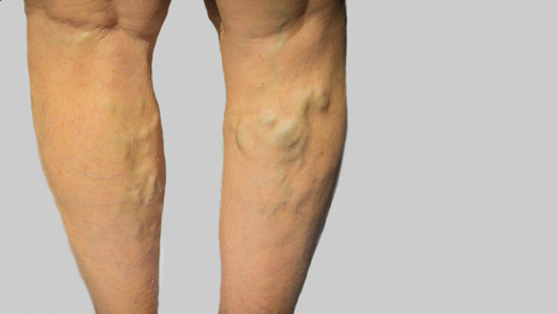 Non-Surgical Treatment for Spider Vein Removal