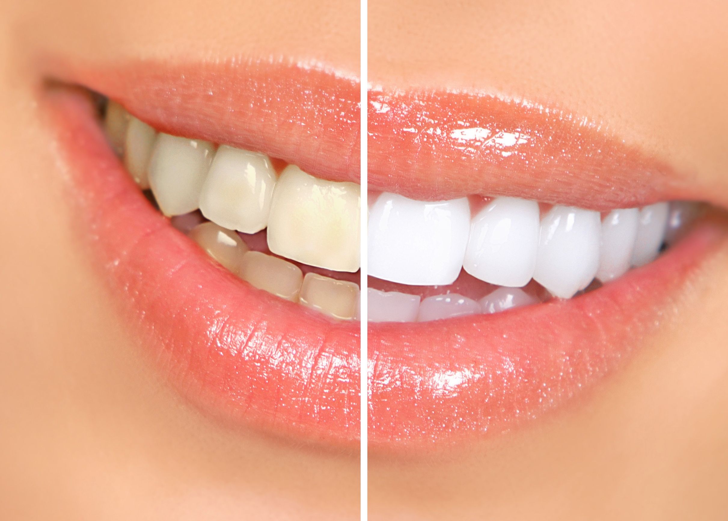 Get Excellent Deals on Dental Veneers in Miami Lakes