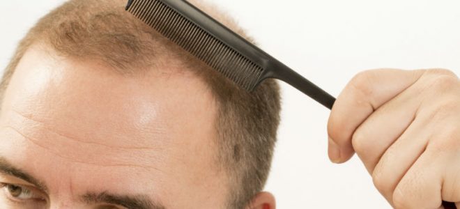 Things to Know When Considering an FUE Hair Transplant in Washington, DC