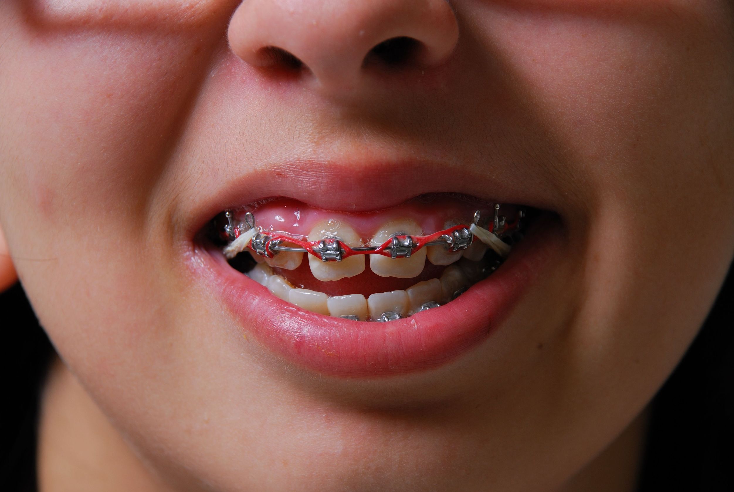 The Importance for Medina, OH Teens of Following Invisalign Guidelines