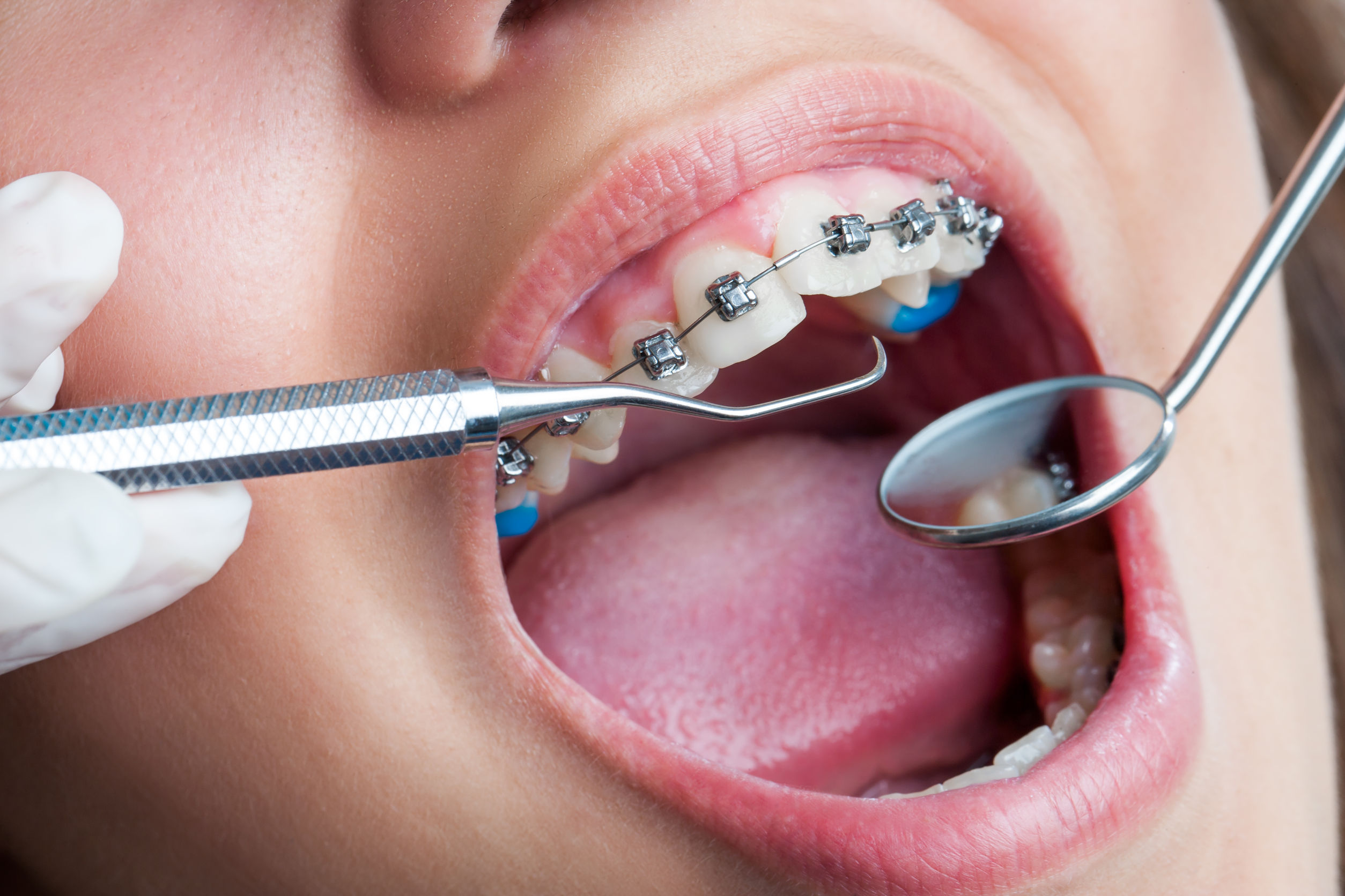 The Long-Term Health Benefits of Looking Into Braces in Medina, OH