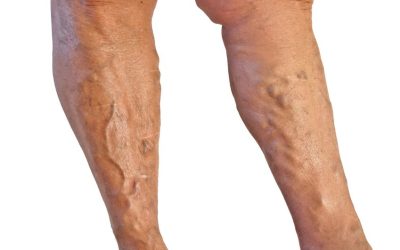 Could You Benefit from Sclerotherapy in Schaumburg