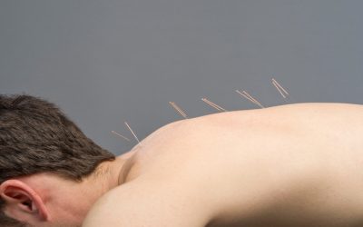 How Acupuncture In Costa Mesa CA Can Help With Headaches And Insomnia