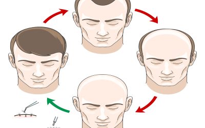 Restore Confidence With Natural Results: Hair Transplant in Syracuse, NY, Solutions That Work