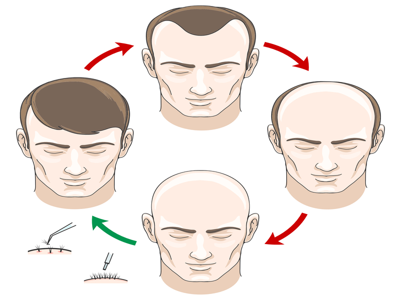 Restore Confidence With Natural Results: Hair Transplant in Syracuse, NY, Solutions That Work